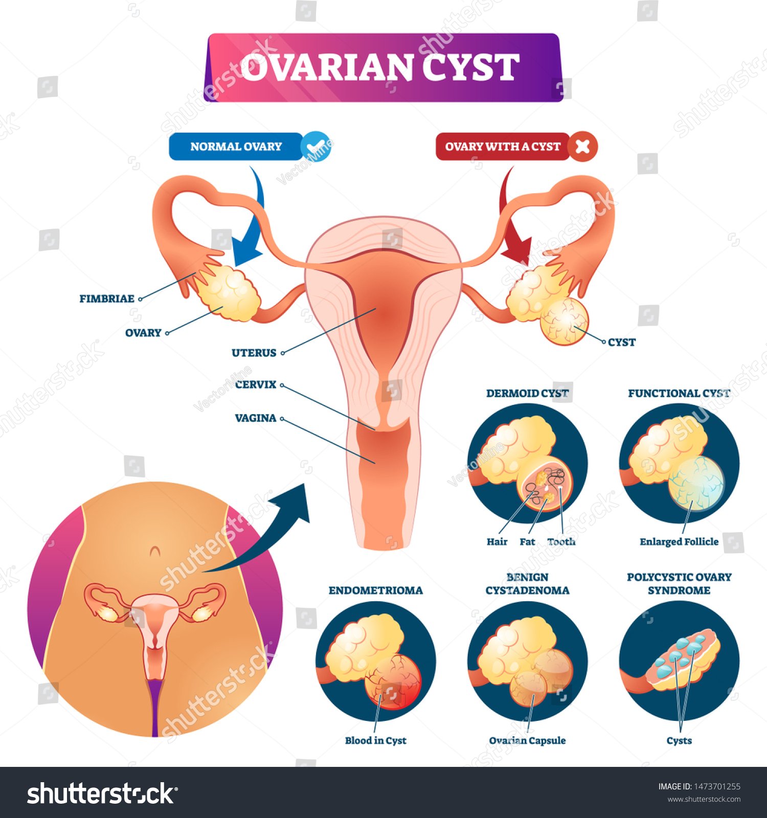 Home stock vector ovarian cyst vector illustration labeled medical condition types scheme anatomical infographic 1473701255