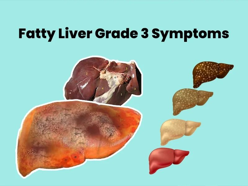 fatty liver 4