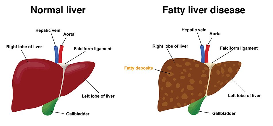 healthy and fatty liver, vector illustration (for basic medical education, for clinics & schools)