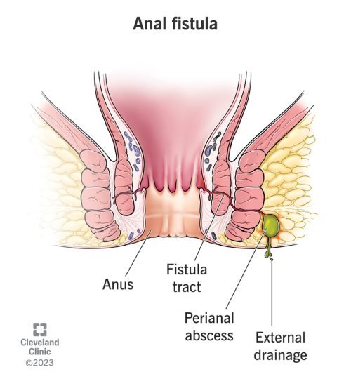 Our Store 14466 anal fistula